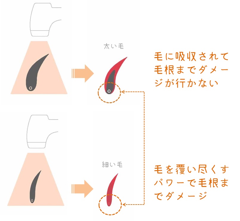 イラスト_細い毛と太い毛　光照射　毛根までの届きやすさ　図解